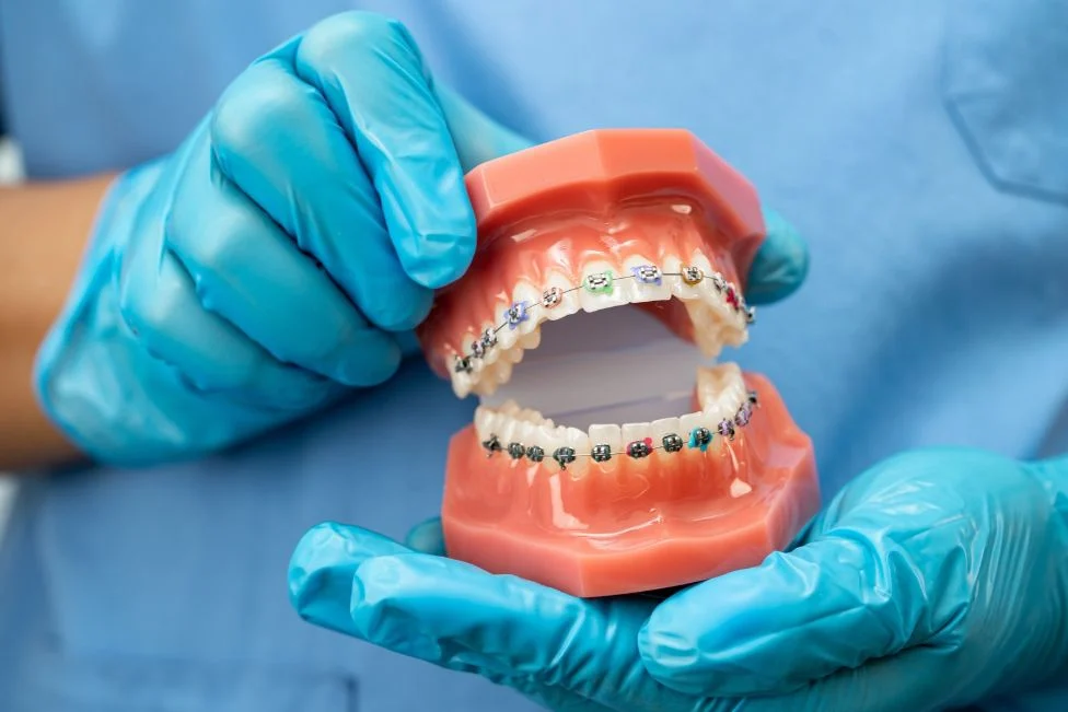 Modelo dental con brackets